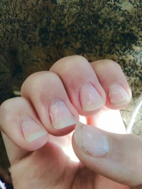 Оторванный гель лак с ногтя. Ногти после снятия гель лака. Сняла гель лак сама. Ногти после снятия нарощенных. Сняла гель лак сама.