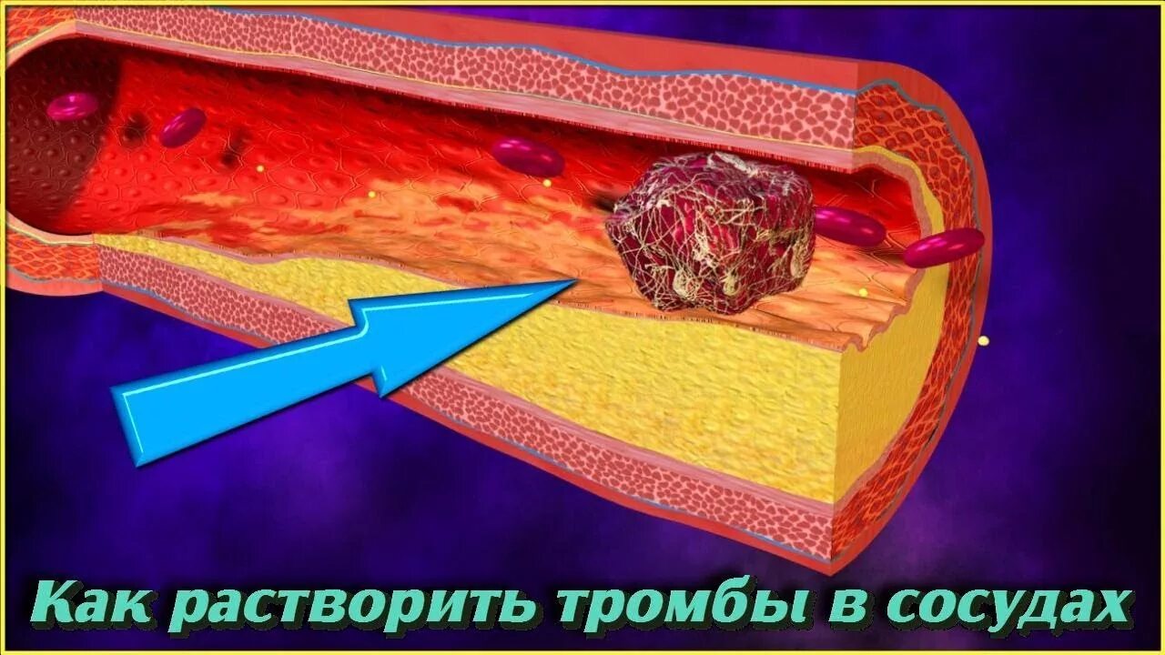 От бляшек и тромбов как очистить