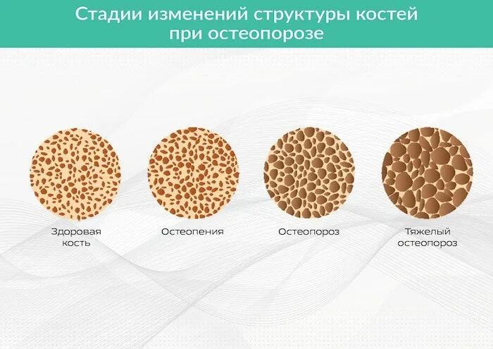 Нарушение структуры костей