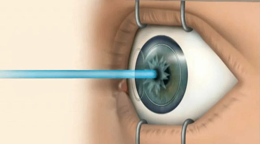Вылечит ли близорукость операция. Аппарат ласик для коррекции зрения. Расширитель глазной ласик.