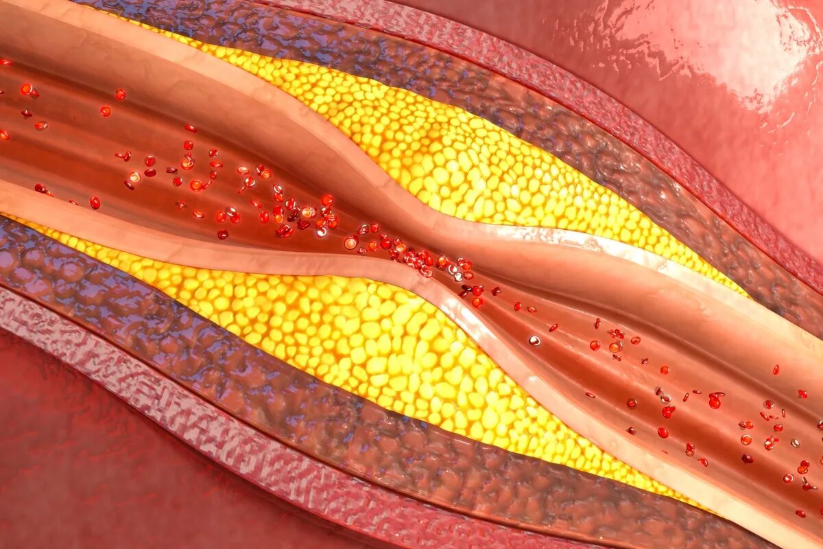 Закупорка кровеносных сосудов. Атеросклерозные бляшки в сосудах.