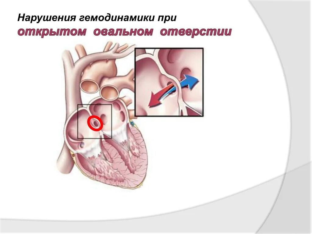 1 3 окно в сердце. Открытое овальное отверстие у новорожденного. Открытое овальное окно аускультация. Что такое открытое овальное окно в сердце у новорожденных. Открытое овальное окно гемодинамика.