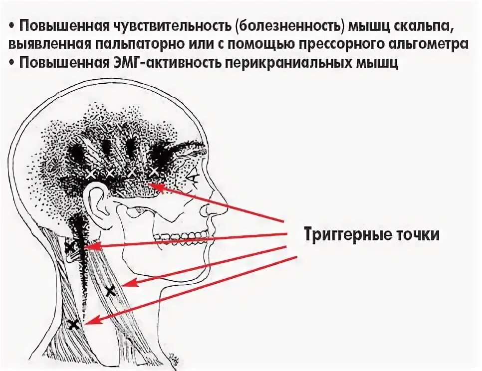 Напряжение головных мышц. Головная боль напряжения триггерные точки. триггерные точки затылочного нерва. точки при головной боли напряжения. головные боли напряжения с перикраниальным напряжением мышц.
