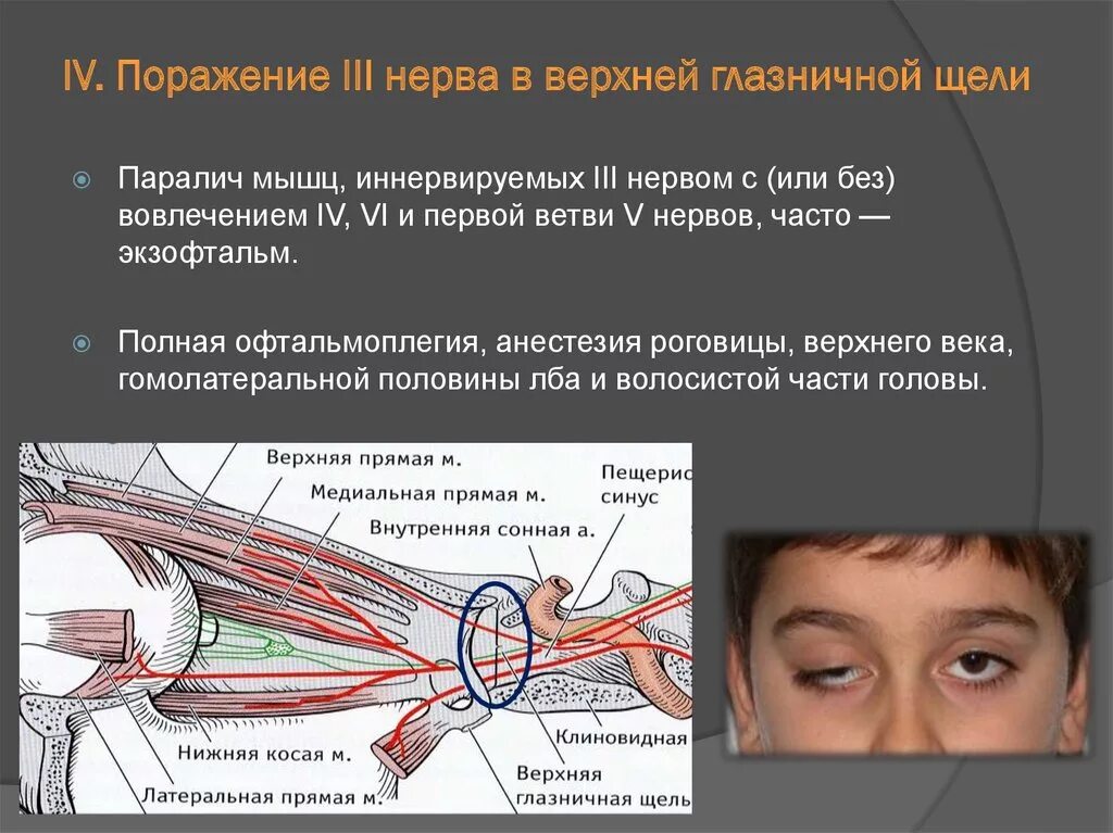 Лечение глазного нерва. Поражение ствола глазодвигательного нерва. Парез 4 нерва глазодвигательного. Глазодвигательный нерв поврежден. Верхняя ветвь глазодвигательного нерва.