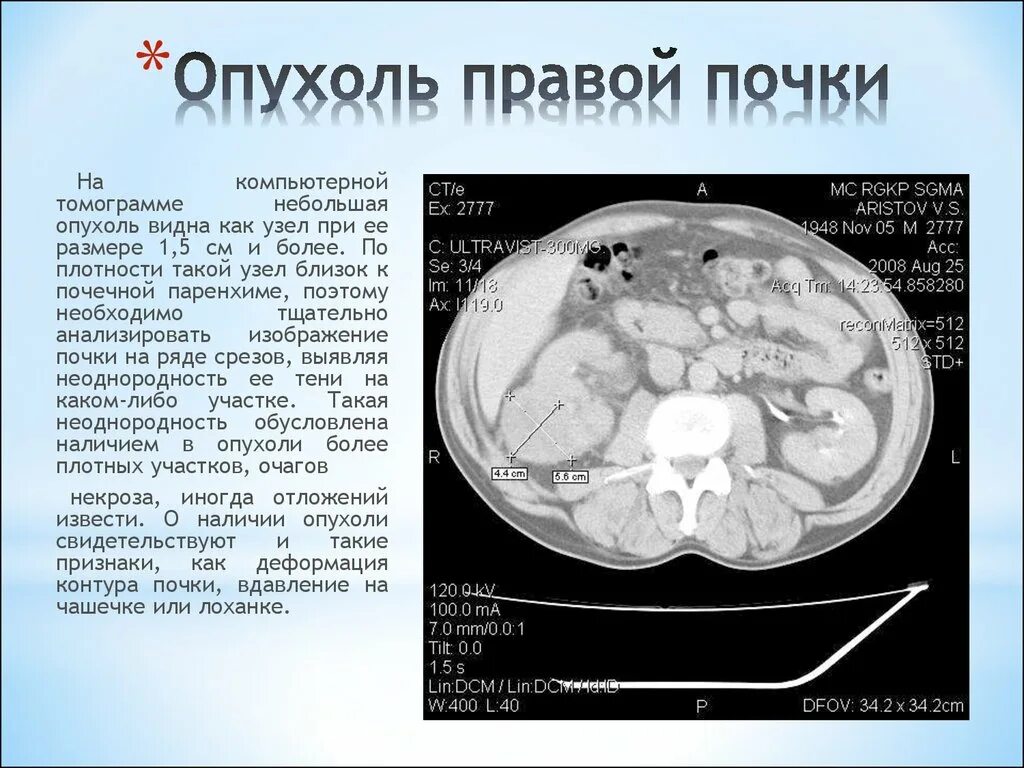 Очаговые изменения почки. Папиллярная опухоль почки кт. Опухоль паренхимы почки кт. Объемное образование почки.