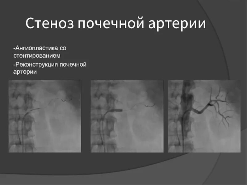 Осложнения стеноза