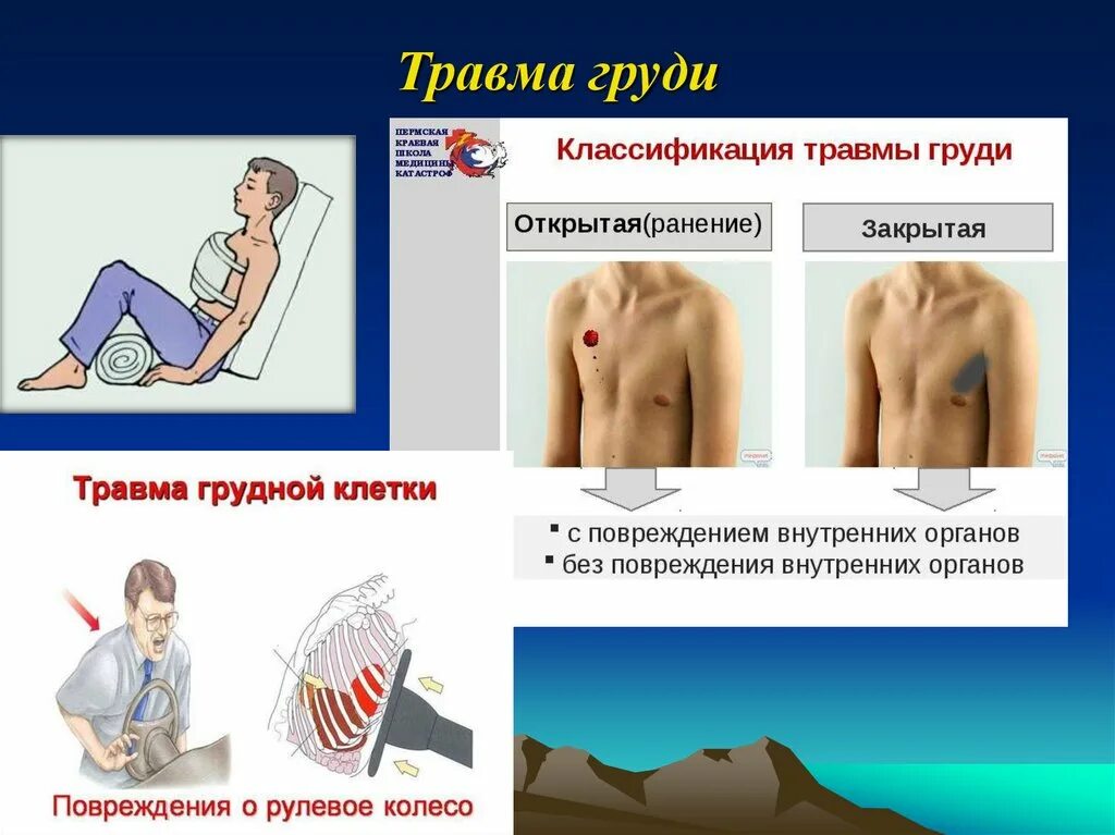 Закрытые и открытые повреждения. Ранение грудной клетки. Закрытая травма грудной клетки.