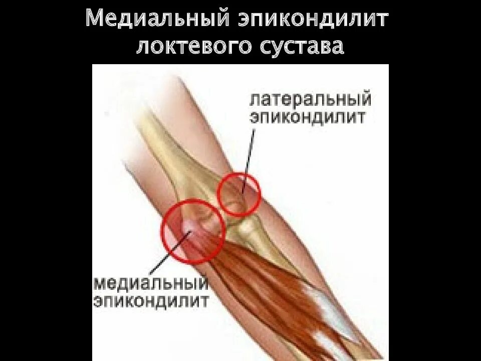 Боль в правом локтевом суставе причина