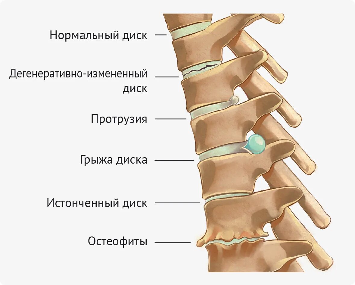 Спинные диски. Остеохондроз протрузии и грыжи позвоночника. Протрузия экструзия грыжа. Грыжа протрузия позвоночника. Протрузия грыжа остеофиты.