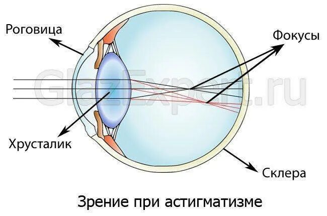 Изображение видимых предметов формируется на а роговице. Зрение при астигматизме. Роговица глаза при астигматизме. Астигматизм и обычное зрение. Близорукость дальнозоркость астигматизм.