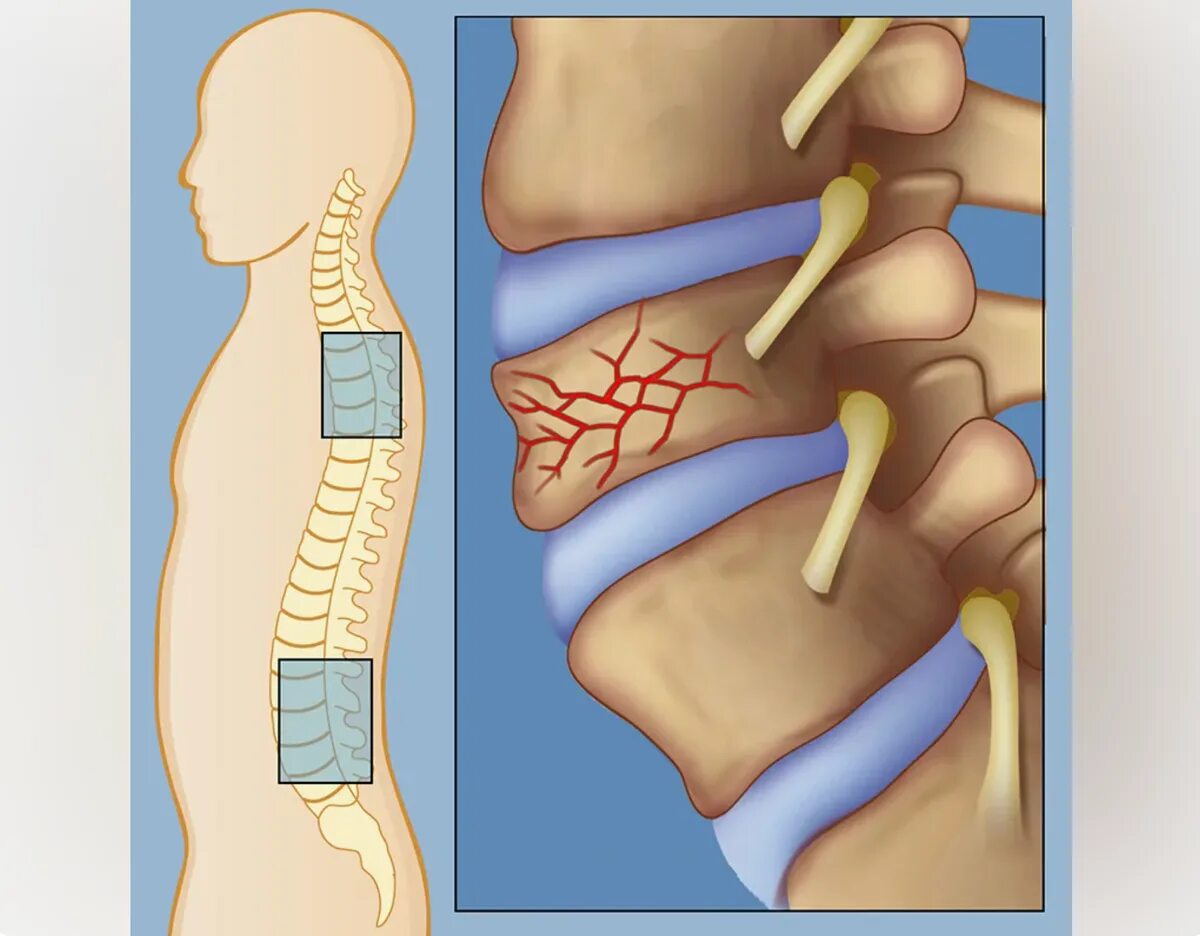 Повреждения позвоночника переломы. Компрессионный перелом тн2. Компрессионный перелом позвоночника l5. Компрессионный перелом позвоночника th-5-6. Компрессионный перелом л 5 позвонка.
