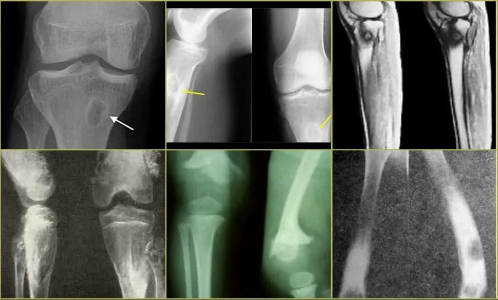 Вторичное поражение костей. Остеомиелит бедренной кости. Посттравматический остеомиелит снимок. Остеомиелит плечевой кости. Токсическая форма острого гематогенного остеомиелита.