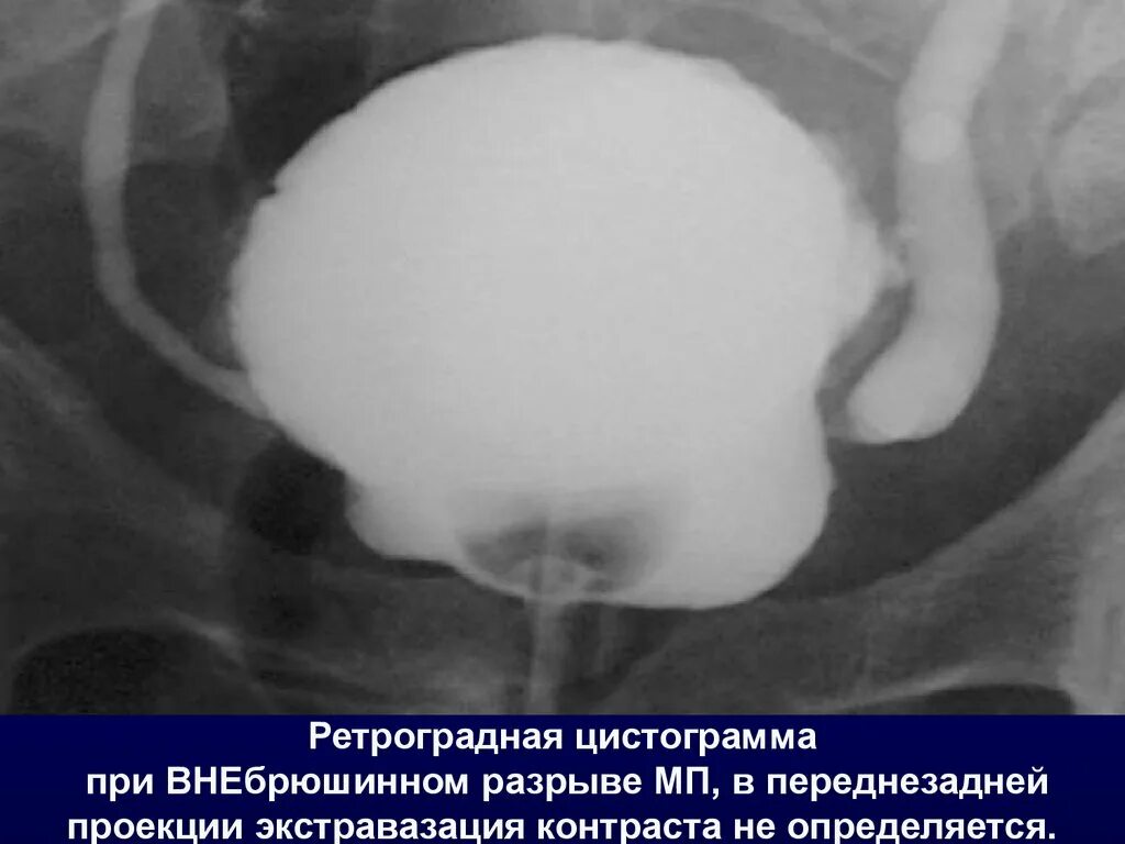Внутрибрюшинный разрыв. Цистография мочевого пузыря протокол травма мочевого пузыря рентген. Внутрибрюшинный разрыв мочевого пузыря рентген. Цистография мочевого пузыря рентген.