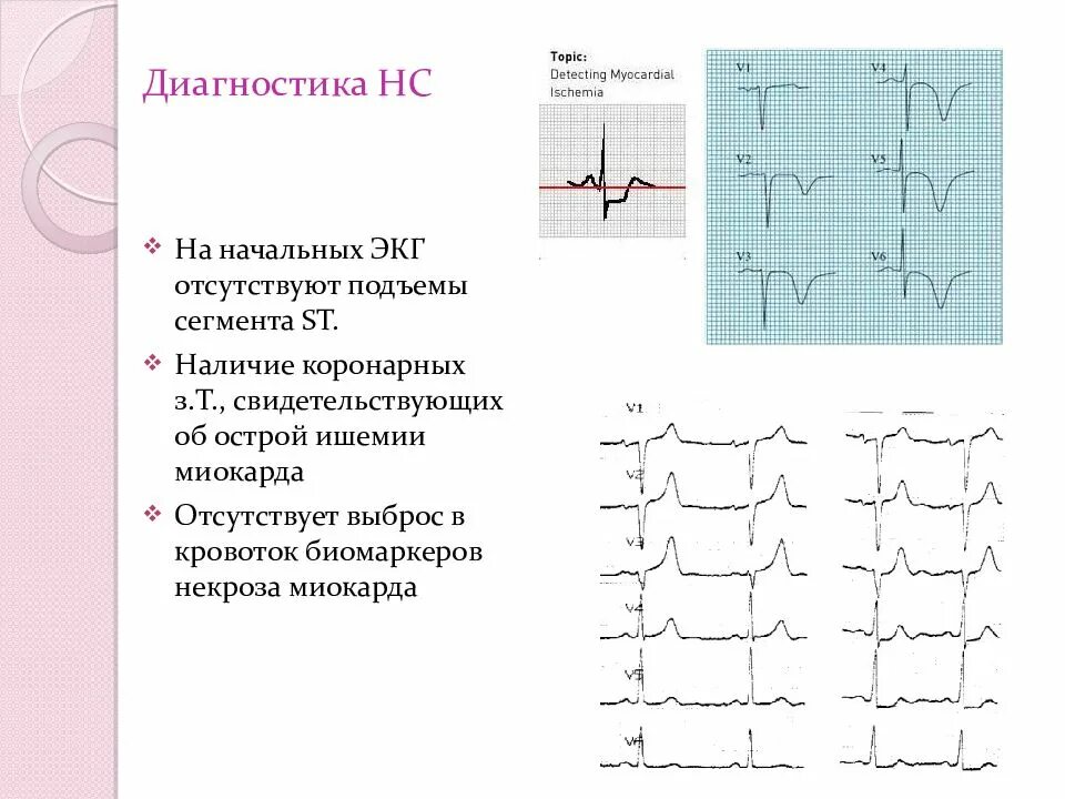 Без подъема st на экг. Подъем сегмента St на ЭКГ v1 v2. ЭКГ при подъеме сегмента St. Подъем сегмента St на ЭКГ v1-v6. Подъём сегмента St на ЭКГ свидетельствует о.