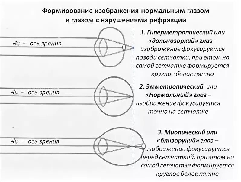 Какое изображение появляется на сетчатке глаза. Построение изображения предмета на сетчатке глаза. Схема построения нормального глаза. Схему построения изображения на сетчатке глаза.. Формирование изображения на сетчатке глаза.