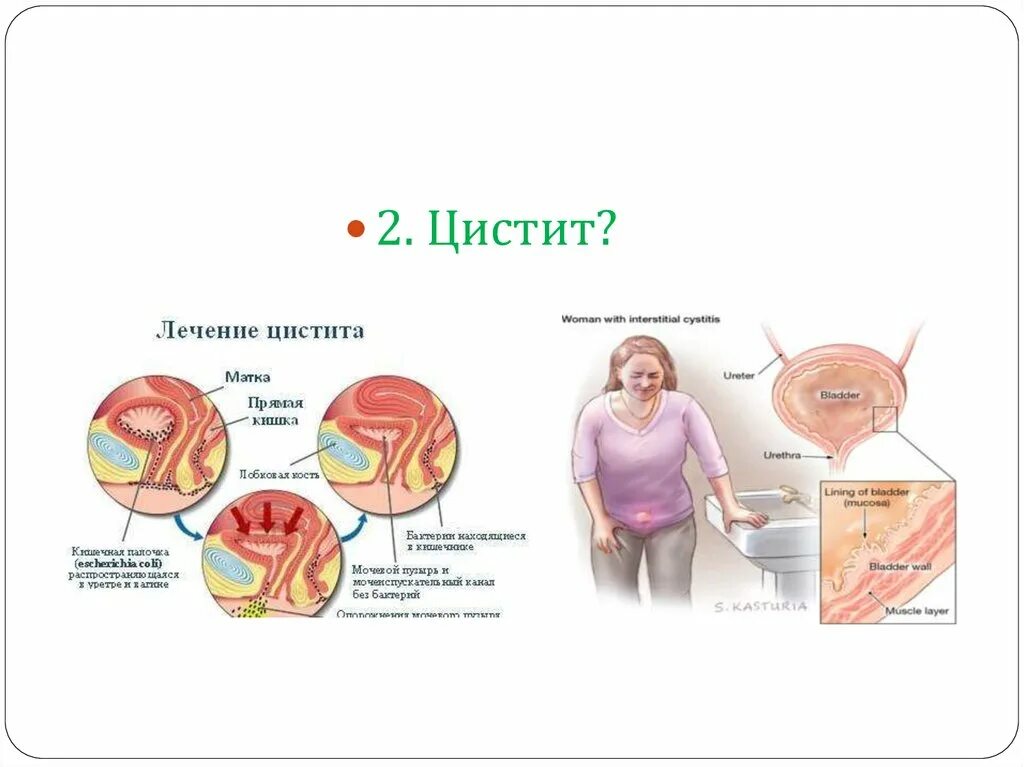 Передается цистит половым путем мужчине. Цистит картинки для презентации.