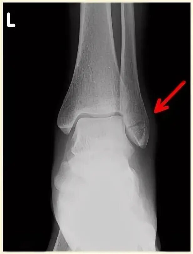 Перелом левого голеностопного сустава рентген. Перелом лодыжки рентген. Перелом рентген левый голеностоп. Латеральная лодыжка рентген.