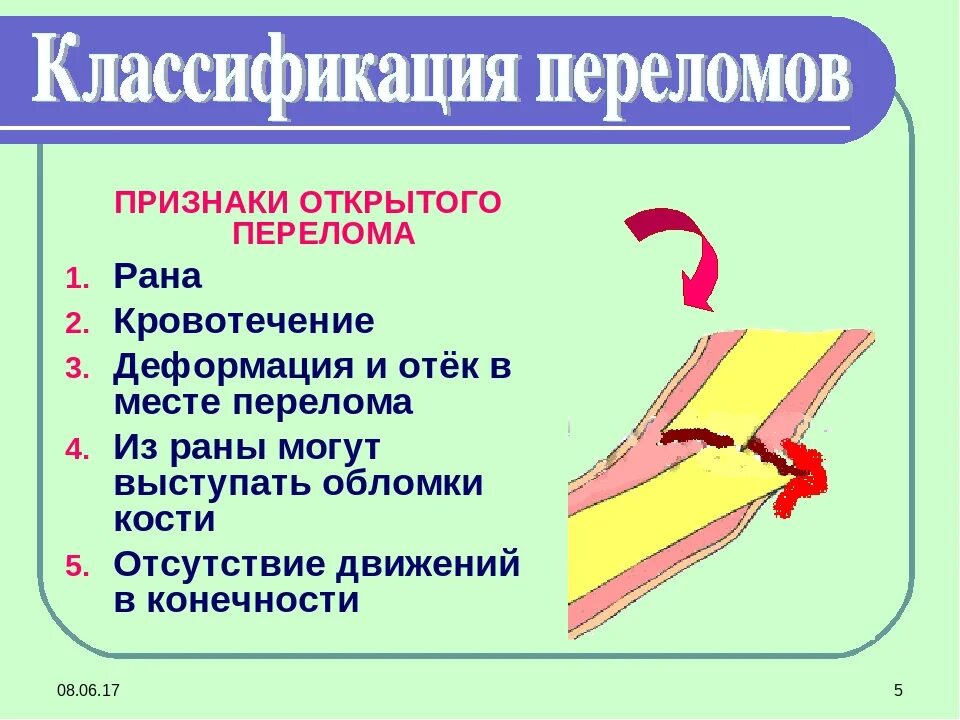 Открытая трещина. Признаки открытого перелома и первая помощь. Открытый перелом признаки. Открытые переломы признаки первая помощь. Симптомы открытого и закрытого переломов.