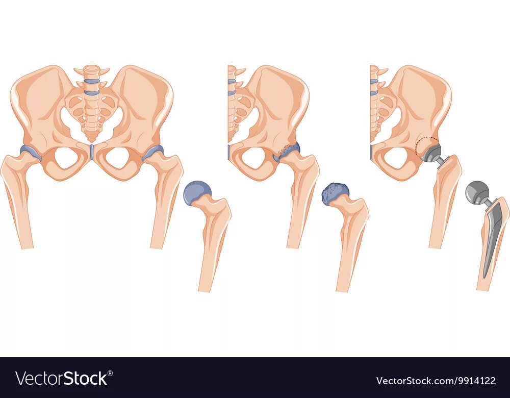 Дисплазия тазобедренных суставов. Эндопротезирование тазобедренного сустава. Имплант тазобедренного сустава. Скелет человека тазобедренный сустав. Тазобедренные суставы производители
