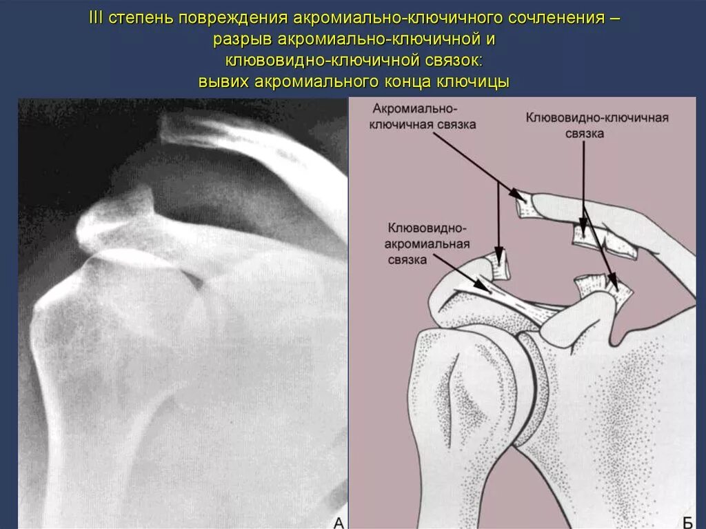 Акромиально-ключичный сустав рентген разрыв связок. Акромиально-ключичное сочленение рентген. Вывих акромиально-ключичного сустава рентген. Разрыв ключично-акромиального сочленения рентген. Разрыв плечевого сустава симптомы