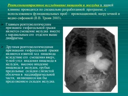 Диафрагмальная грыжа причины
