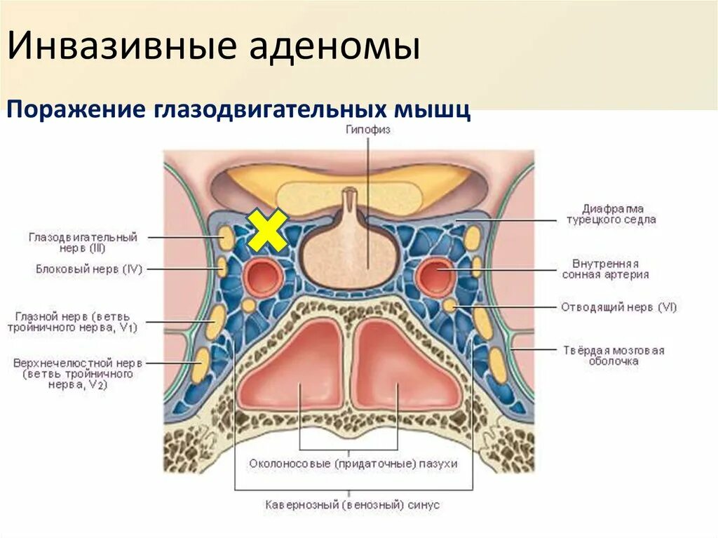 Синдром толоса