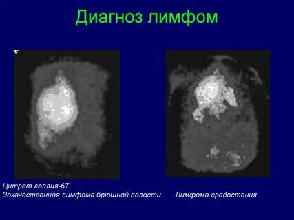 Злокачественная опухоль лимфомы