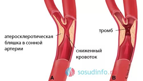 Артерия тромб удаление