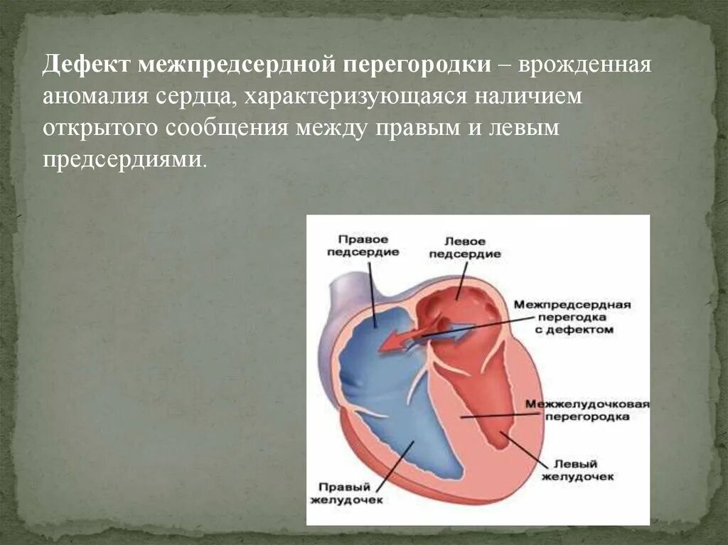 Дефект перегородки. Межпредсердный порок сердца. дефект межпредсердной перегородки макропрепарат. сетчатый дефект межпредсердной перегородки. дефект межпредсердной перегородки нормы.