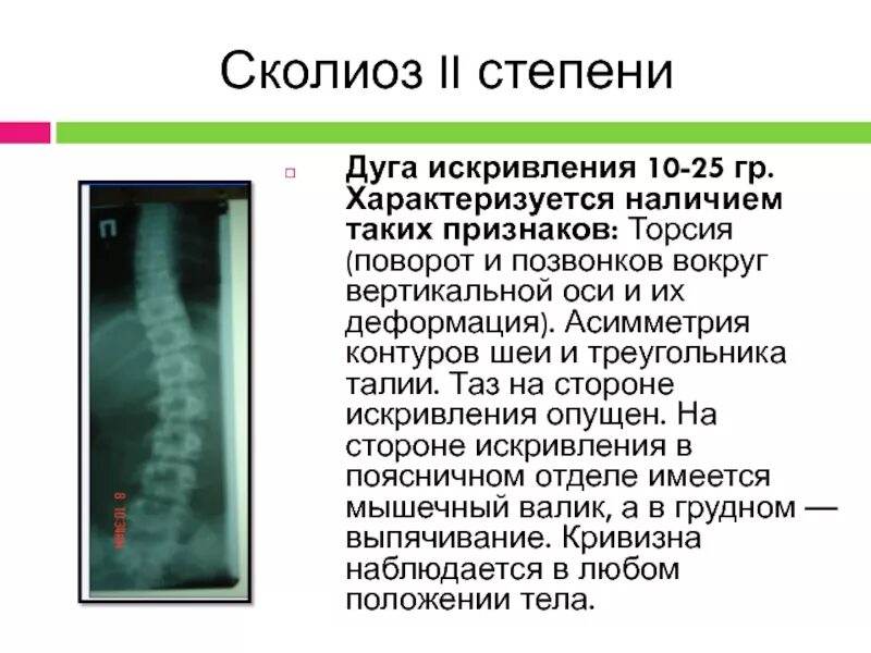 Степени искривления позвоночника. Искривление позвоночника рентген. Сколиозе степень искривления позвоночника. Сколиоз 2 степени это