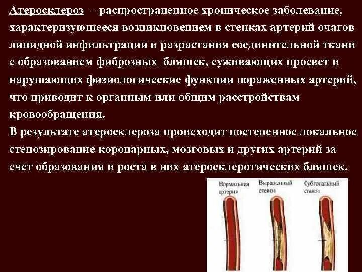 Выраженный атеросклероз. Атеросклероз характеризуется. Атеросклероз что это за болезнь простыми словами