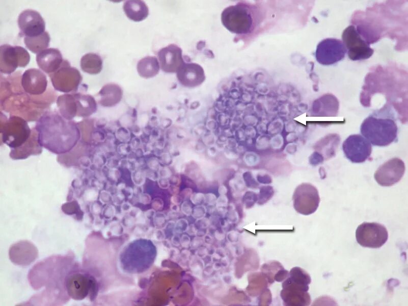 Гистоплазмоз это. Histoplasma capsulatum микроскопия. гистоплазмоз возбудитель. псевдомицелий гистоплазмоз.