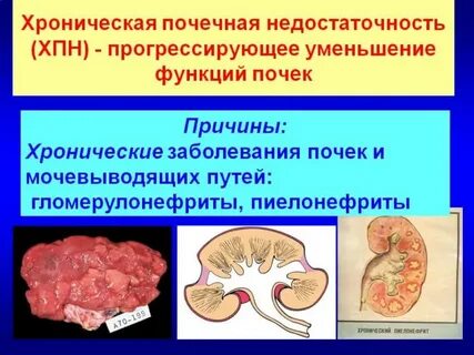 Хронические почечные заболевания