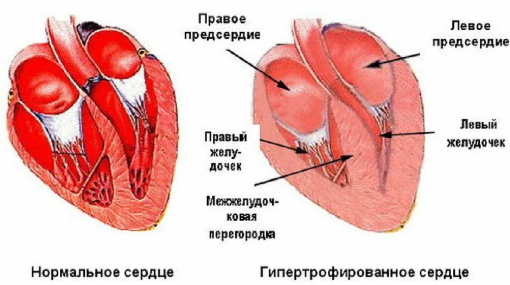 Миокард правого предсердия. Левый желудочек сердца гипертрофирован. Сердце кошки гипертрофическая кардиомиопатия. Стенки сердца.