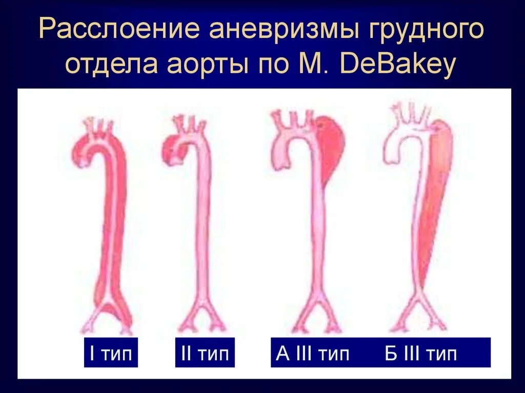 Расслаивающаяся аневризма аорты. Дебейки классификация аневризм аорты. аневризмы аорты по дебейки. аневризма аорты 1 тип по дебейки. расслоение аневризмы по дебейки.