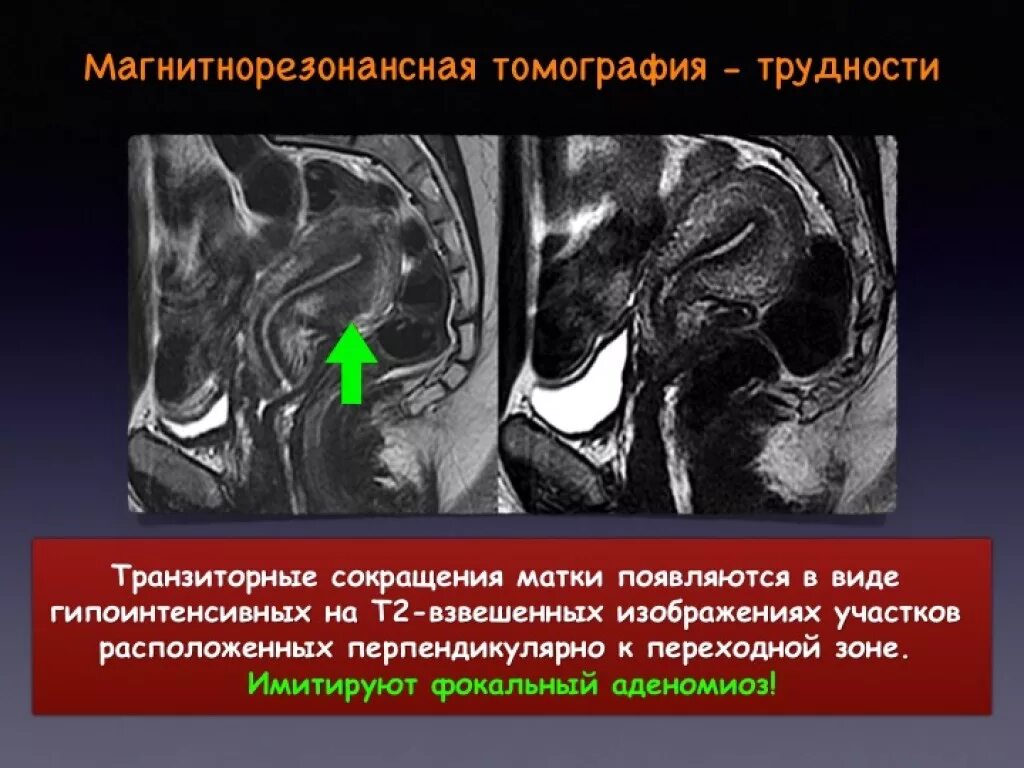 Кистозный аденомиоз мрт. Аденомиоз на мрт малого таза. Аденомиоз тела матки мрт.