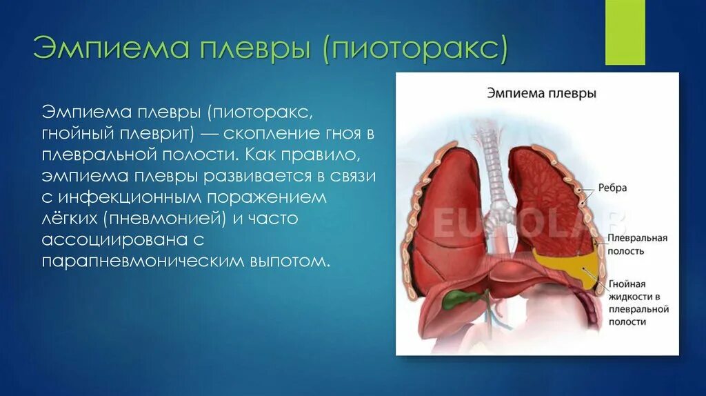 Гнойный плеврит (эмпиема). Эмпиема плевральной полости справа. Гнойный плеврит эмпиема плевры. Эмпиема гнойное воспаление. Эмпиема легкого