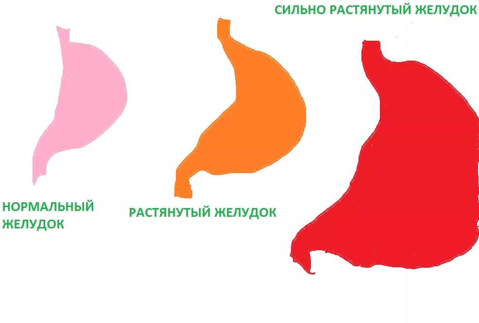 Нормальный и растянутый желудок. Насколько может растянуться желудок.