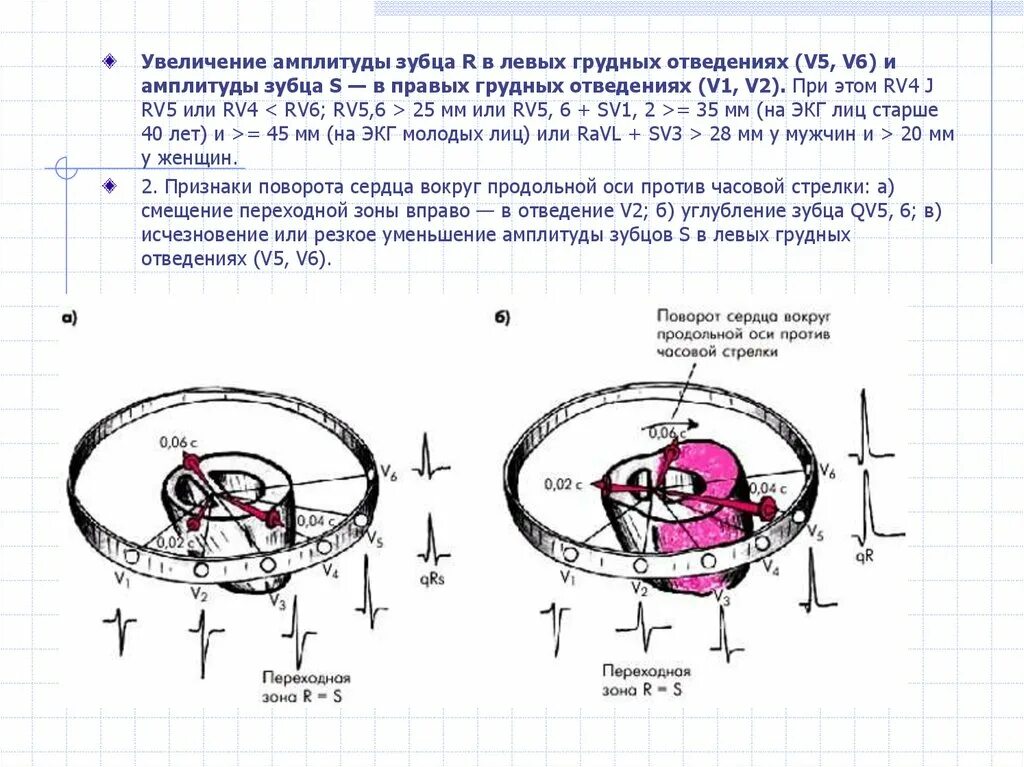 Повороты сердца на ЭКГ вокруг продольной оси. Определение поворотов сердца вокруг продольной оси. ЭКГ признаки поворота сердца вокруг продольной оси. Повороты сердца вокруг оси на ЭКГ. Поворот правым желудочком вперед