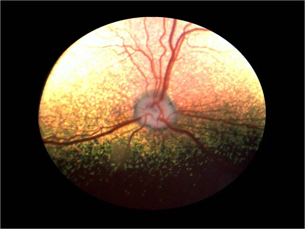 Офтальмоскопия глазного дна норма. Топография глазного дна. Зрительный нерв глазное дно норма. Неврит зрительного нерва. Периневральное пространство зрительного нерва