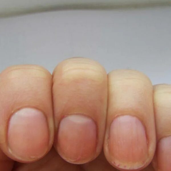 Полоски на ногтях причины вертикальные у женщин. Продольные борозды на ногтях. Продольные полоски на ногтях.
