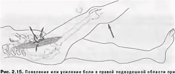 После аппендицита сколько нельзя поднимать. Ретроцекальное расположение аппендикса. особенности течения острого аппендицита. атипичное течение аппендицита. поднять ногу при аппендиците.