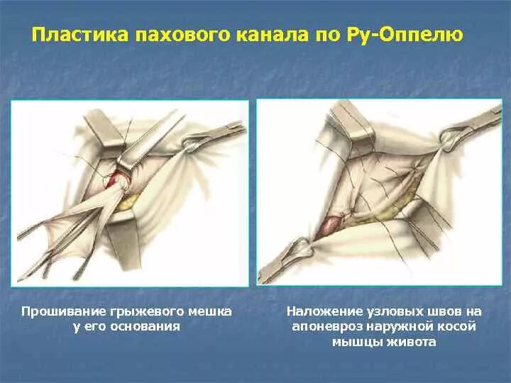 Паховая грыжа методы лечения. Операция грыжесечения. Пластика передней стенки пахового канала по ру. Пластика передней стенки паховой грыжи. Пластика передней стенки пахового канала при косых паховых грыжах.