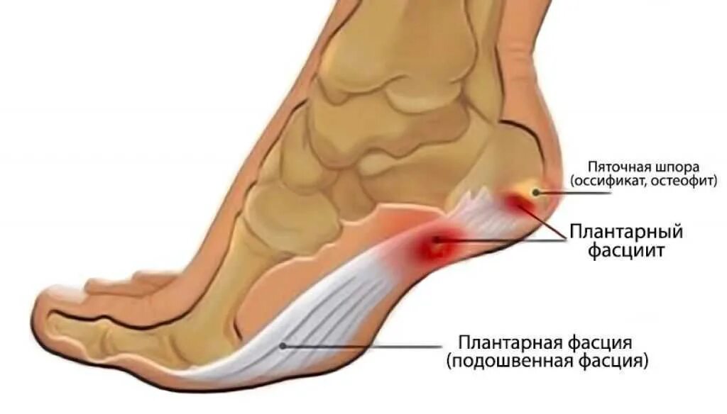 Фасцит в пятке при ходьбе лечение. Плацентарный фасциит стопа. плантарный фасциит пятки. подошвенный фасциит свода стопы. что такое плантарный фасцит стопы.