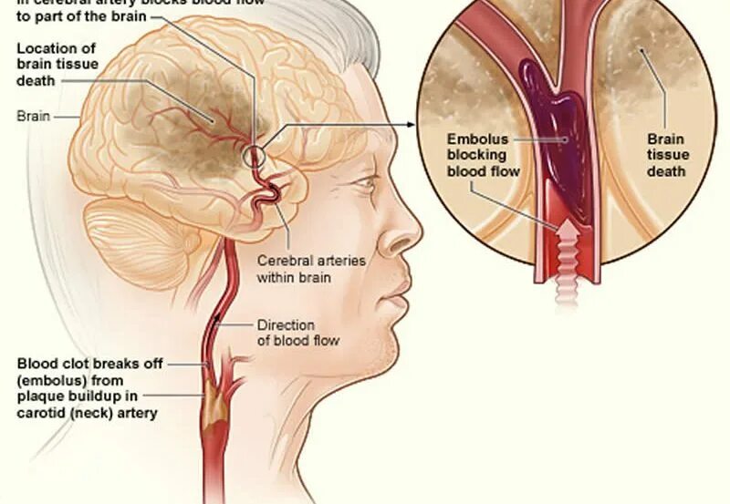Тромб после инсульта. Тромбоз мозговых артерий. Ишемический инсульт общемозговые симптомы. Ишемический эмболический инсульт. Ишемический инсульт тромб.