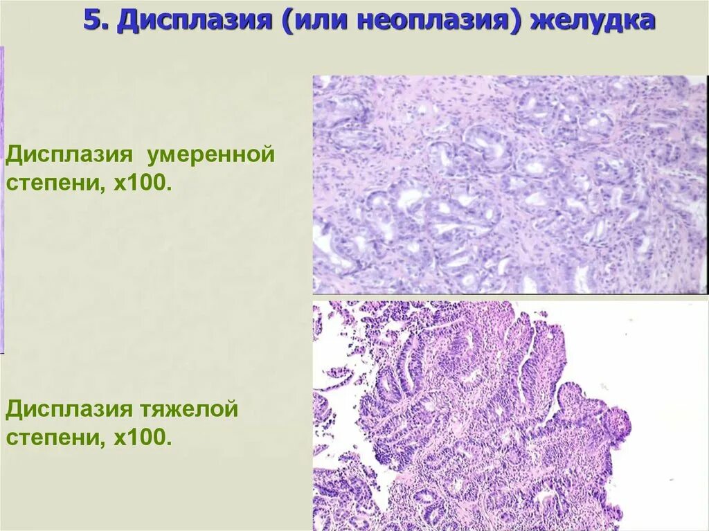 Неоплазия железистого. Дисплазия степени гистология. Дисплазия эпителия гистология. Дисплазия гистопрепарат. Дисплазия желудка гистология.