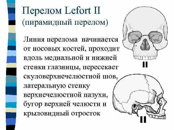 Перелом лицевого черепа