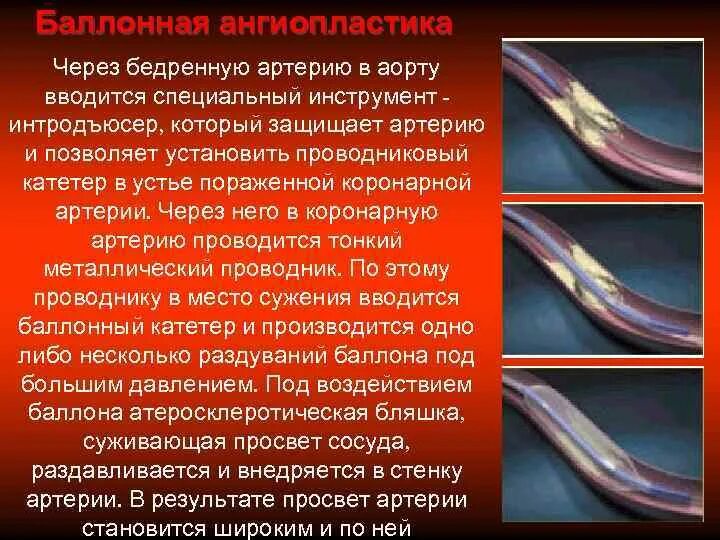 Лечение инфаркта стентирование