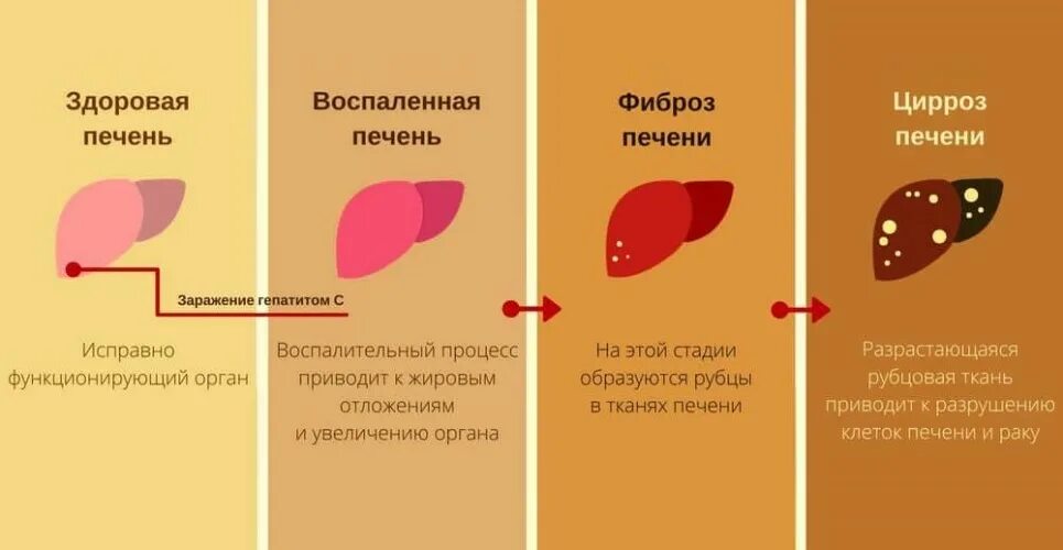 Больная печень и температура. Этапы формирования цирроза печени. Цирроз печени стадии развития. Фазы развития цирроза печени. Стадии развития алкогольного цирроза печени.