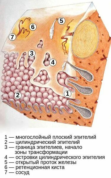 Парацервикальные кисты. Ретенционные кисты шейки. Ретенционные кисты шейки матки. Мелкие кисты шейки матки. Кистозно расширенная железа